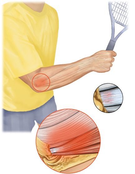 Tenisçi Dirseği (Lateral Epikondilit)