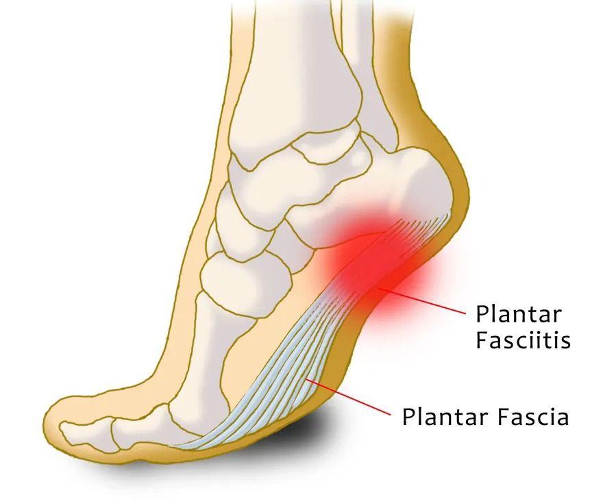 Plantar Fasiit