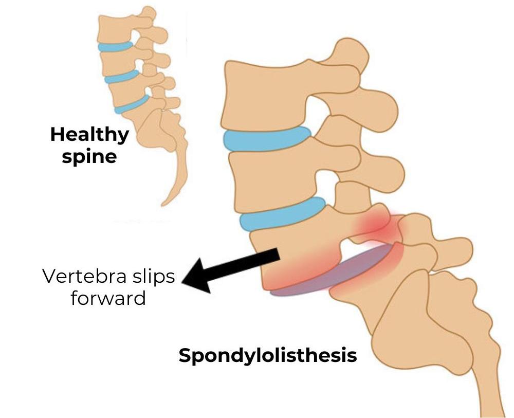 Spondilolistezis (Bel Kayması)