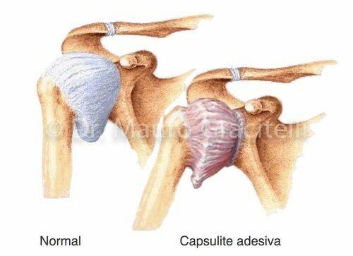 Donuk Omuz (Adheziv Kapsülit)