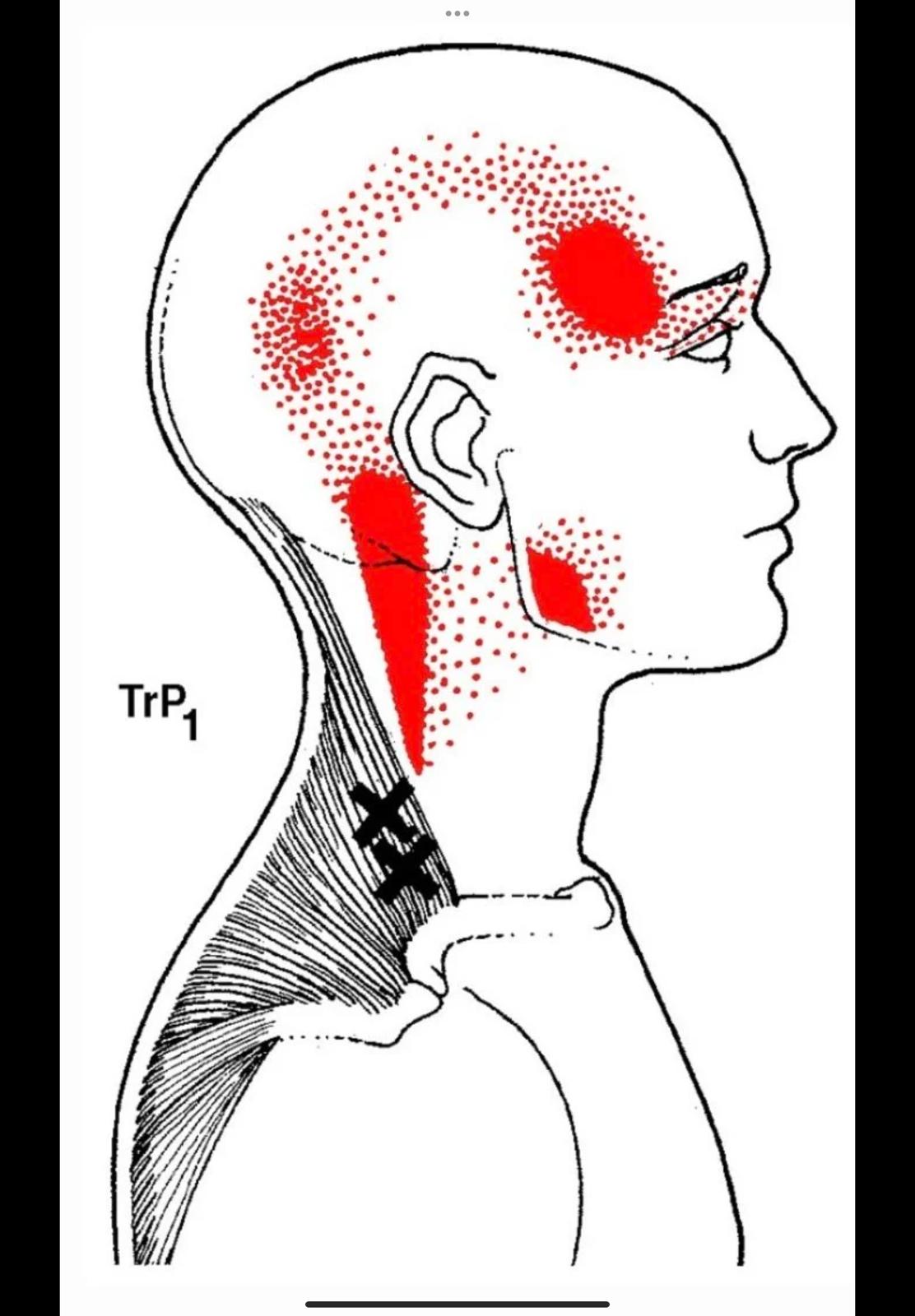 Servikojenik Baş Ağrısı